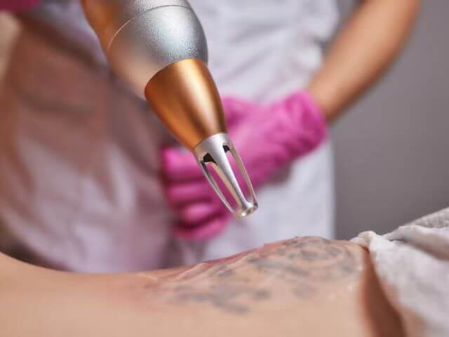 baeutician tattoo removal