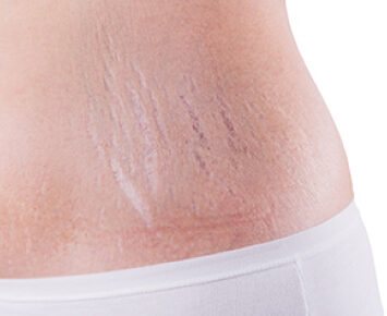 strech marks
