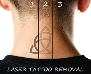 tattoo removal megatron