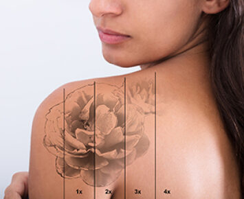 tattoo removal