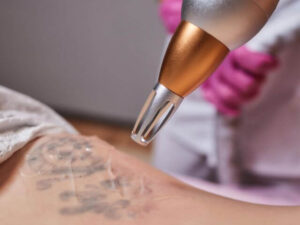 tattoo removal